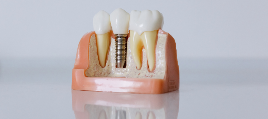 Dental Implants