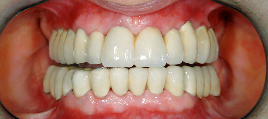 Full Mouth Reconstructions