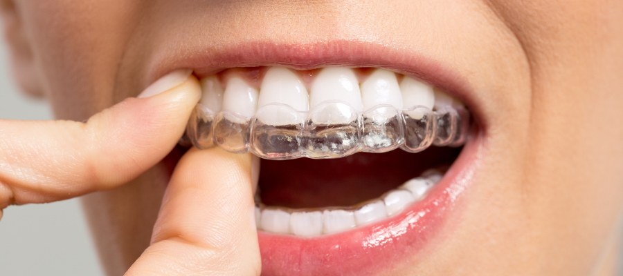 Invisible Braces Treatment