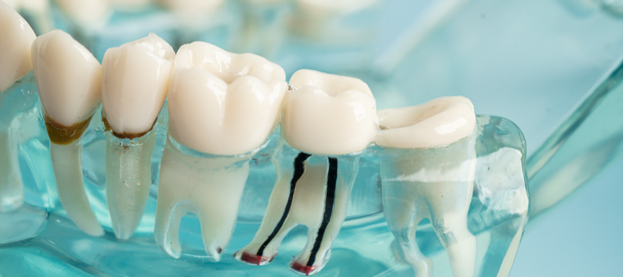 Root Canal Treatment