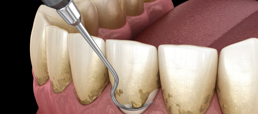 Teeth Cleaning Treatment